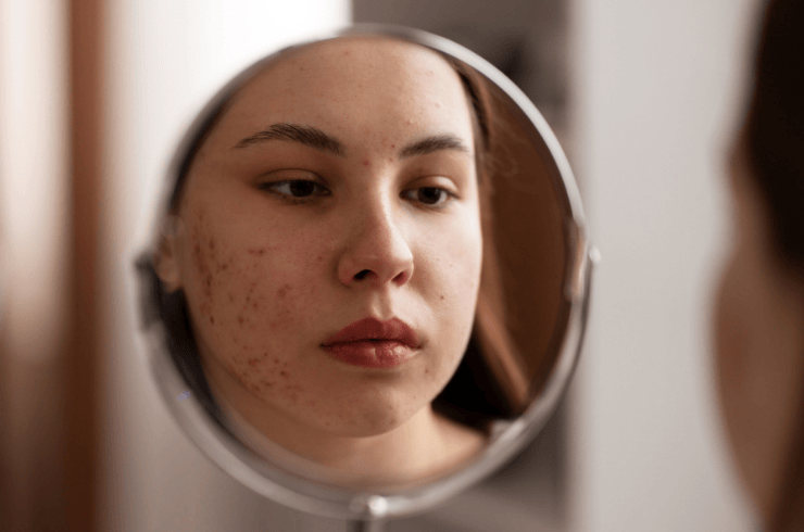 Acne & Acne Scar Treatment